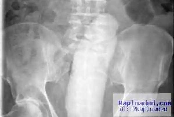 68-Year-Old Man Undergoes Emergency Surgery To Remove Stuck Huge s*x Toy